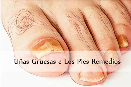 uñas gruesas de los pies remedios